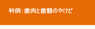 歯肉と歯髄のやけど 歯肉と歯髄のやけど